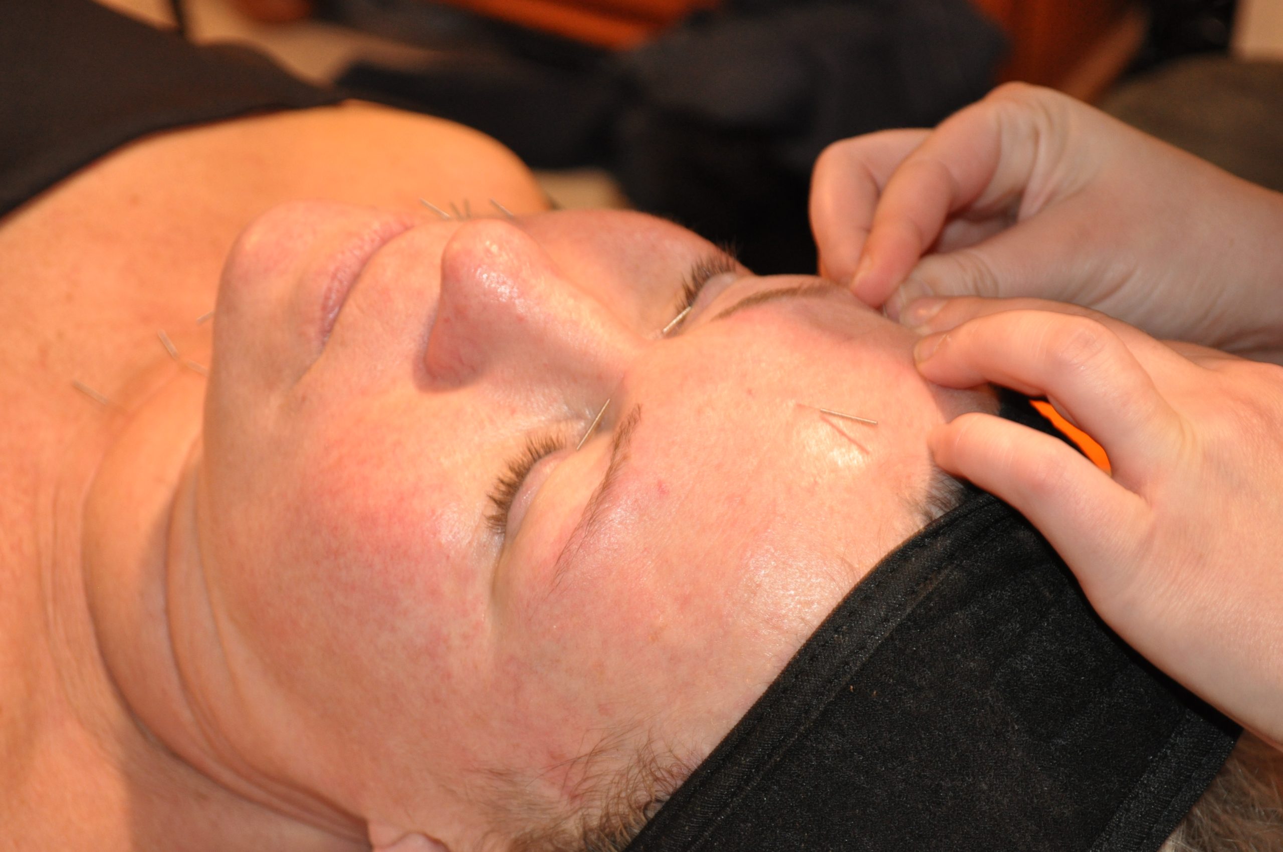 Facial Acupuncture 4 Facial Acupuncture Mobile TCM