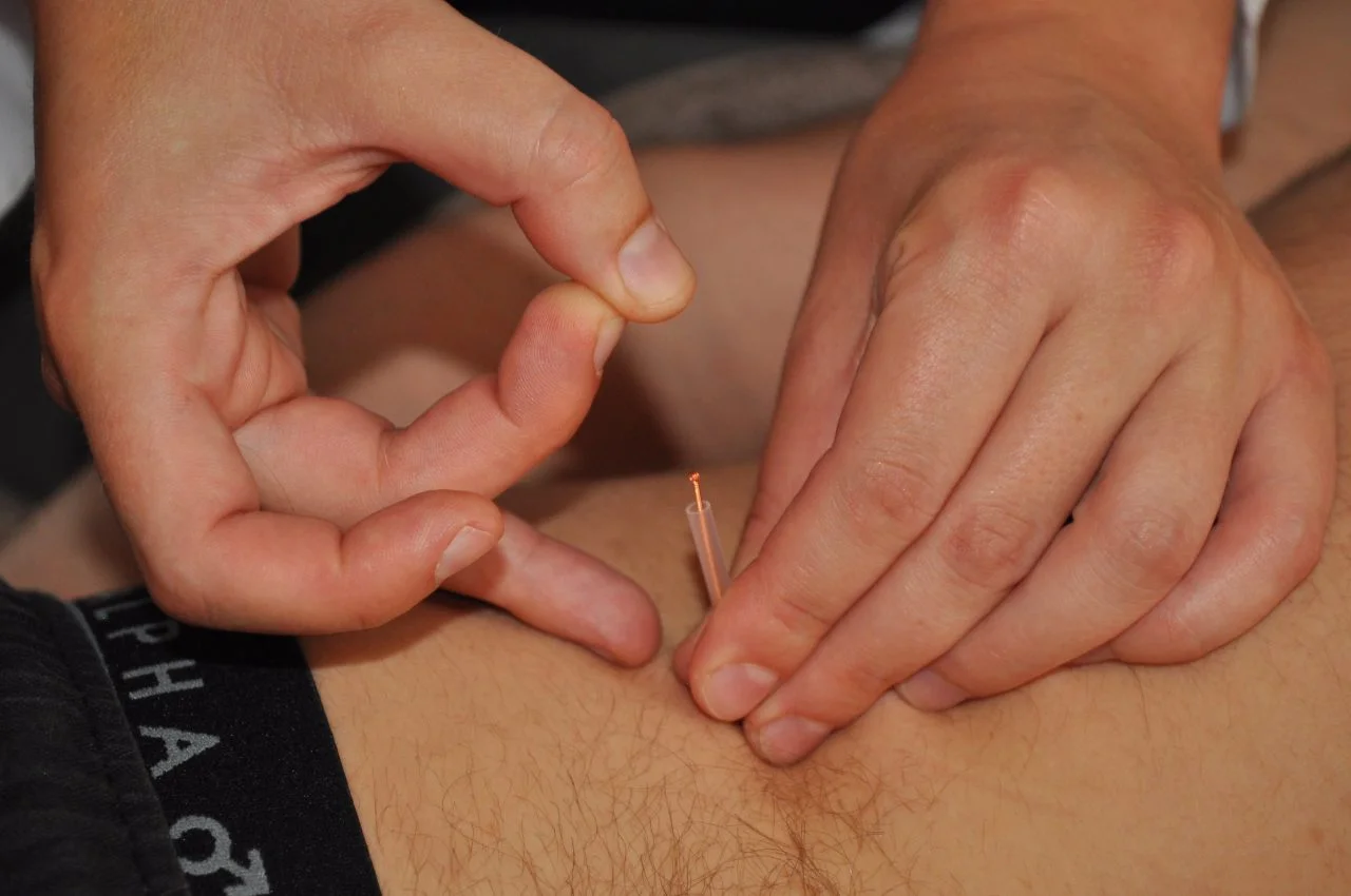 Acupuncture